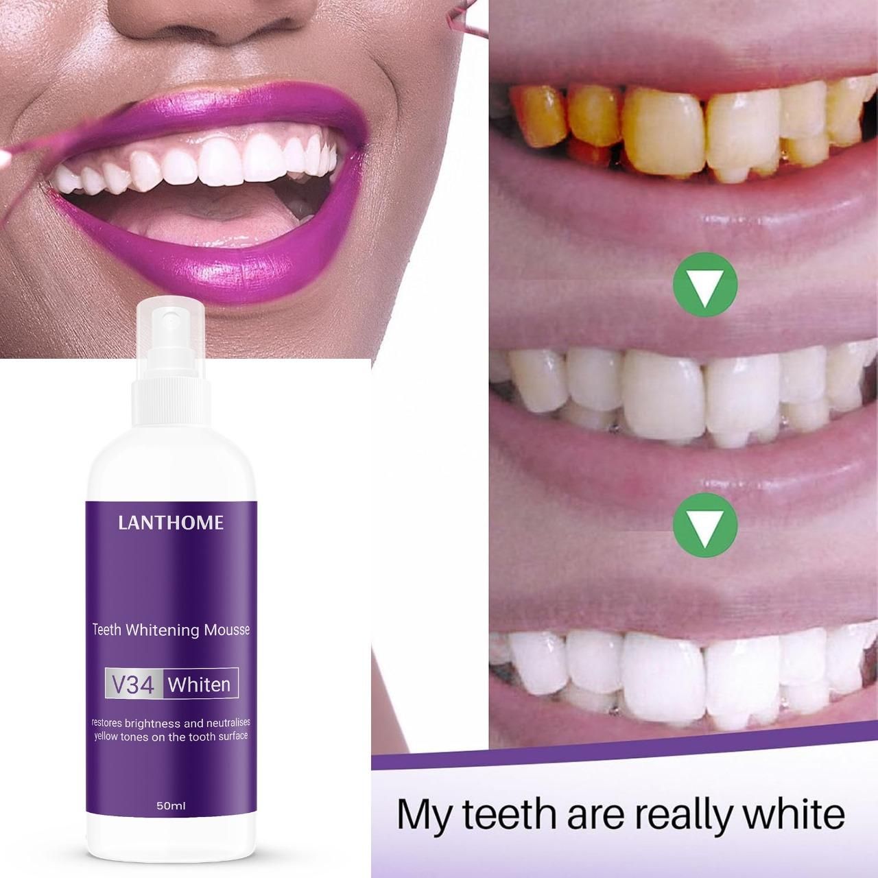 Lanthome V34 Teeth Whitening Spray Mousse – 50ml (Pack of 2) | Removes Stains, Brightens Smile & Reduces Sensitivity