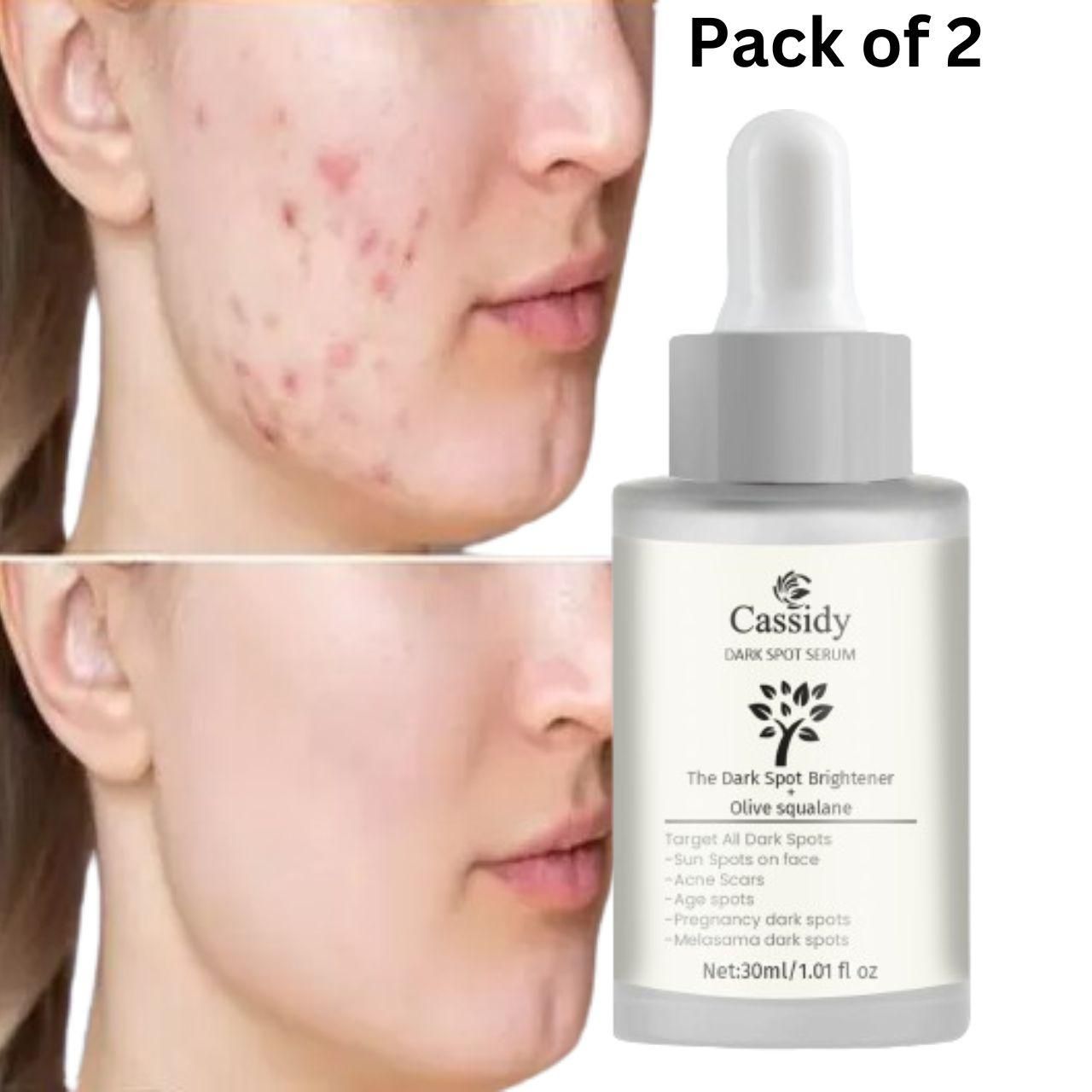 CASSIDY Dark Spot Serum with Olive Squalane – 30ml Each (Pack of 2) | Brightens Skin, Fades Acne Scars & Dark Spots
