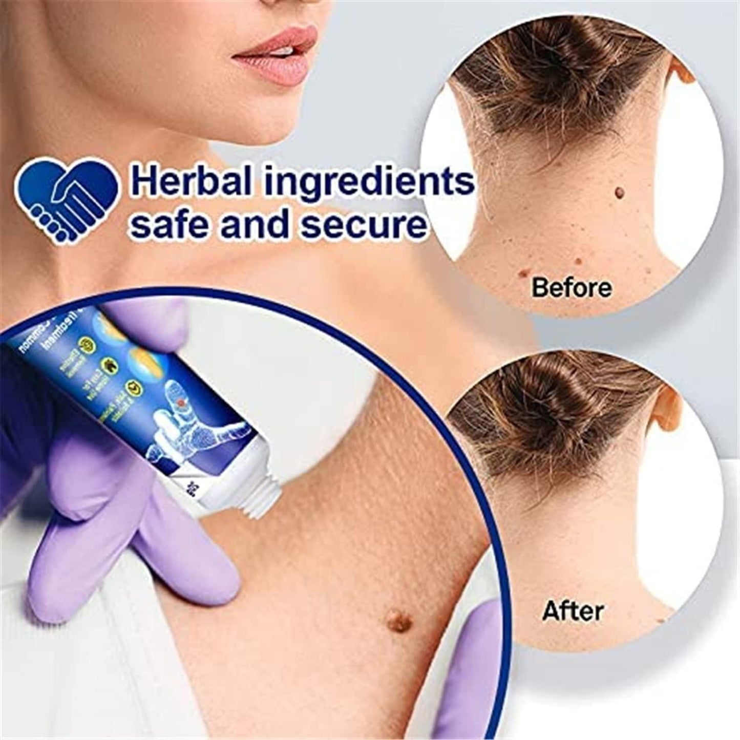 Wart Remover Ointment for All Skin Types  (Pack of 1) | 20g Ointment