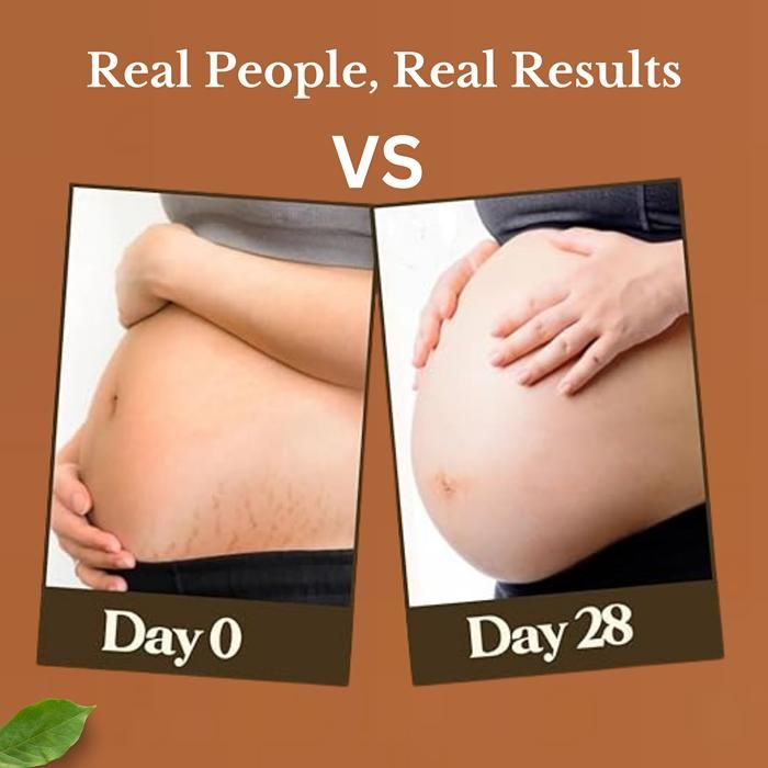 Natural Stretch Marks Cream 50g – Fades Scars, Improves Skin Elasticity & Firms Skin | Fast-Absorbing, Non-Greasy Formula