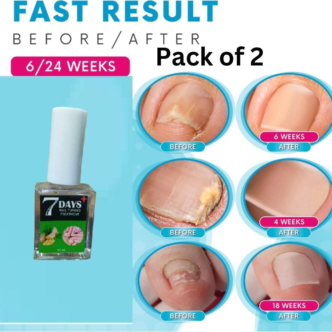 7 Days Nail Fungus Treatment Polish (Pack of 2) – Antifungal Liquid for Damaged Toenails & Fingernails | Fast, Effective Nail Repair at Home