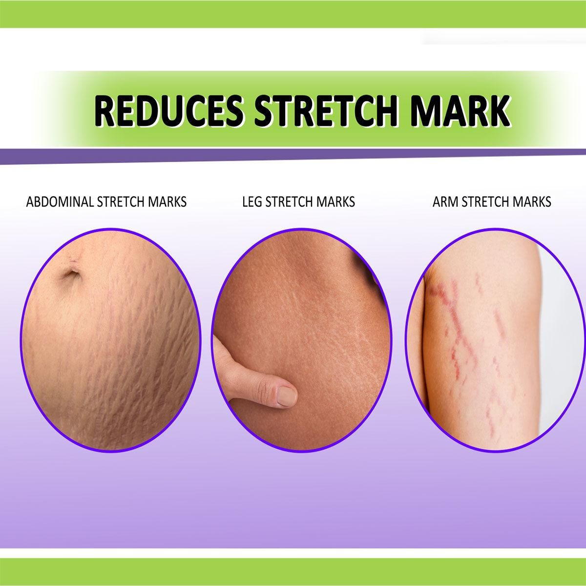 Panchvati Herbal Body Gel for Stretch Marks 100gm – Enriched with Natural Oils & Gotu Kola | Firms, Hydrates & Reduces Scars | For Women